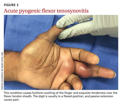 flexor tenosynovitis of finger icd 10|left extensor tenosynovitis icd 10.